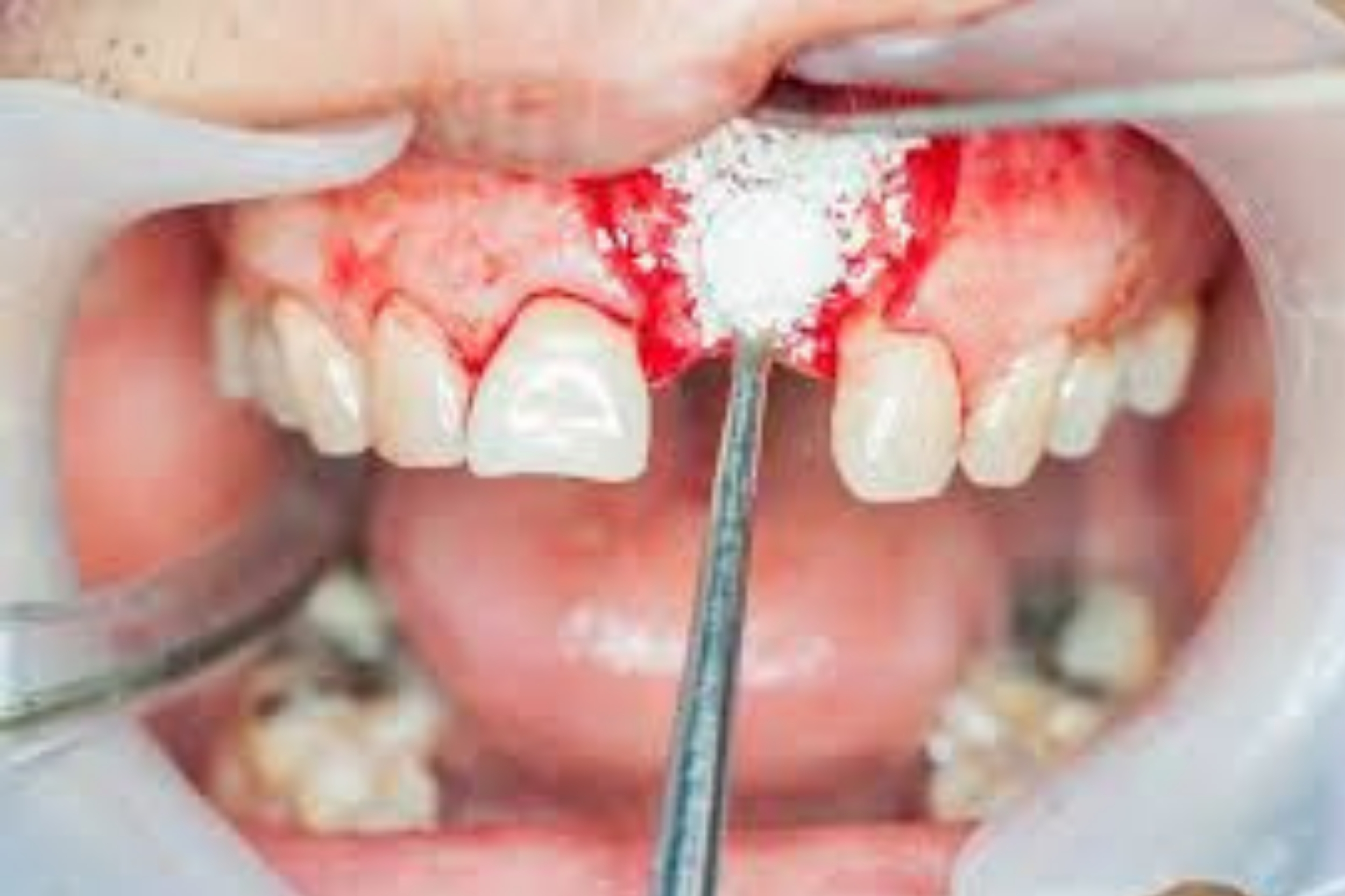 Advance Bone Grafting.jpg