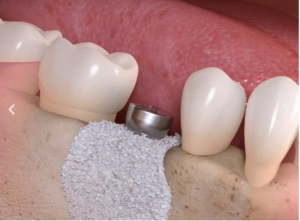 Advance bone grafting