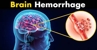 Brain Hemorrhage Treatment In Nagpur