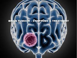 Brain Tumor Treatment in Nagpur