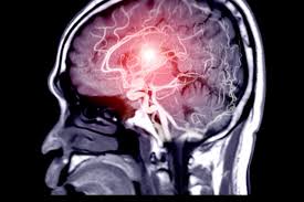 Cerebrovascular Surgery