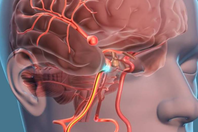 Cerebrovascular Surgery