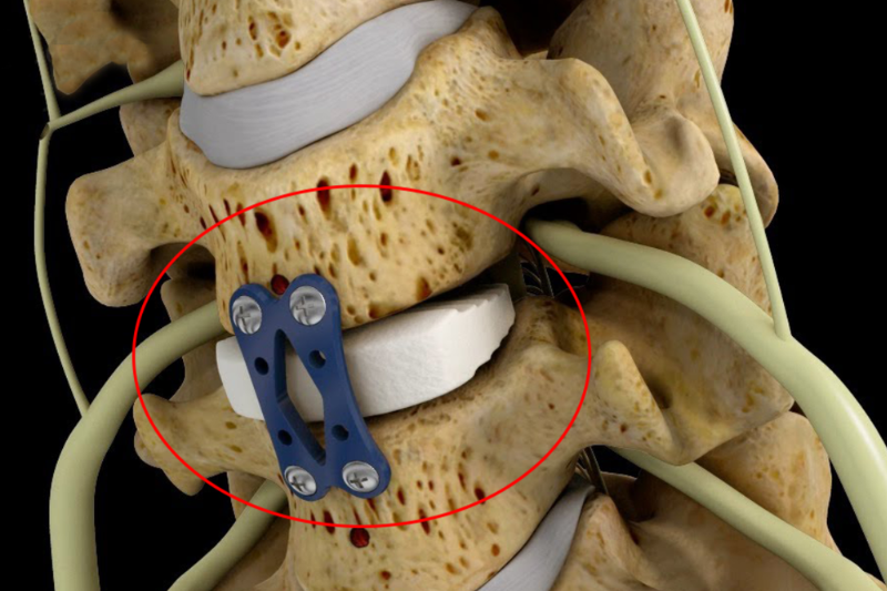 Cervical Disc Surgery