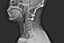 Cervical Disc Surgery