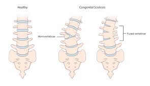 Congenital Spine Malformation