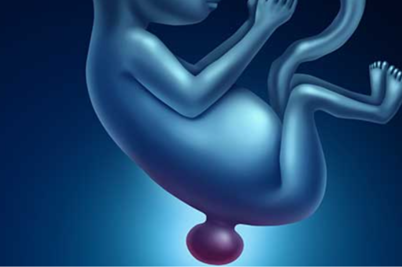 Congenital Spine Malformation