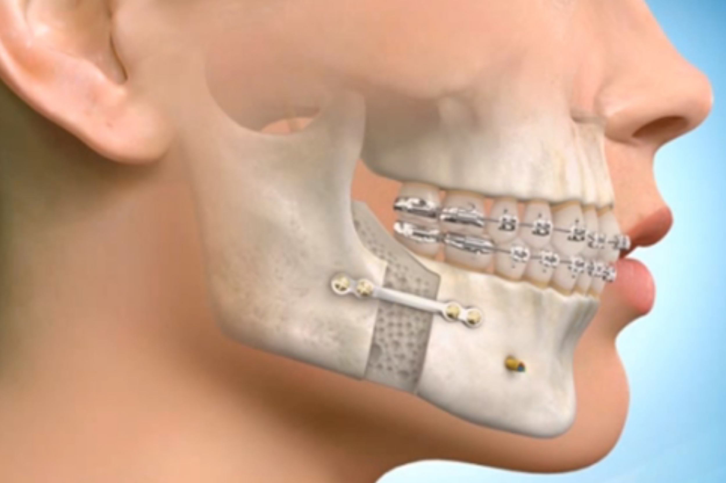 Full Mouth Rehabilitation.jpg