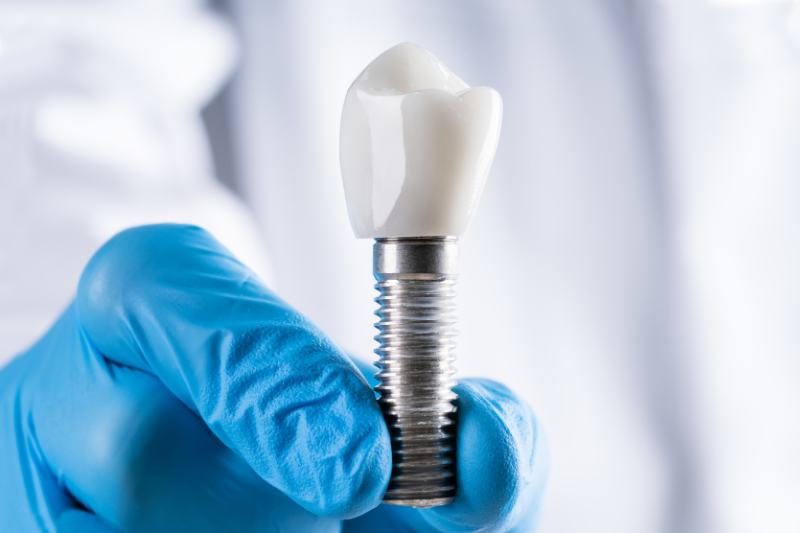 Dental Implants