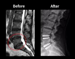 Disc Replacement Surgery In Nagpur