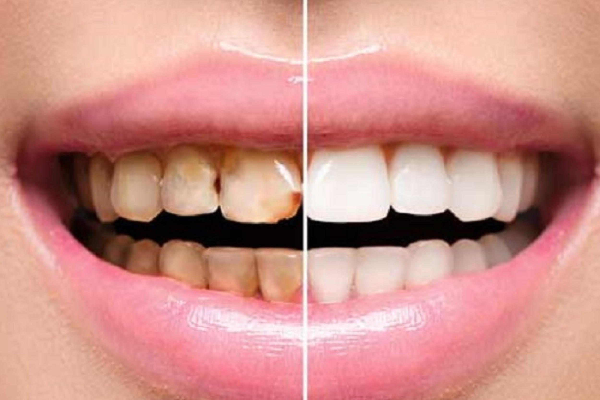 Full Mouth Rehabilitation.jpg