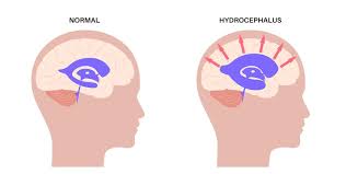 Hydrocephalus