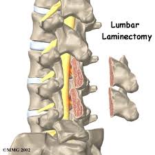 Laminectomy Surgery In Nagpur
