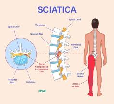 Lumbar Disc Surgery and Sciatica