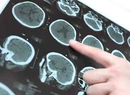 Neuro Specialist In Gondia