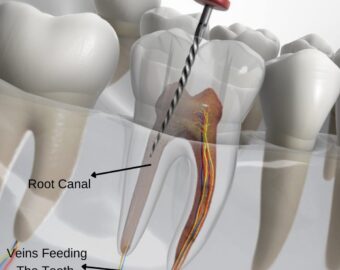 Root canal