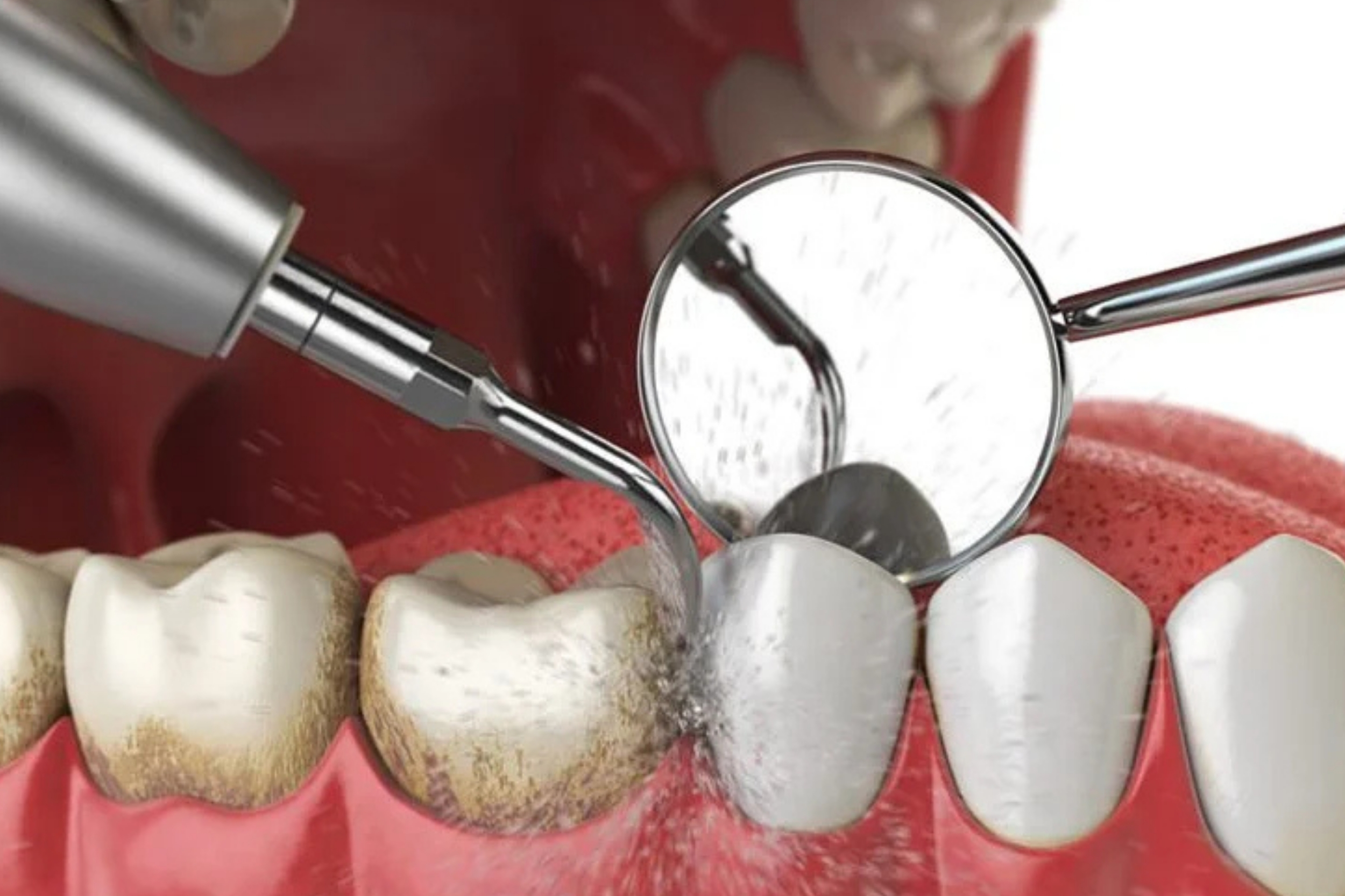 Scaling and Polishing.jpg