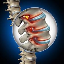 Spine Specialist in Shahdol