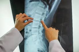 Spine Surgeon In Gadchiroli
