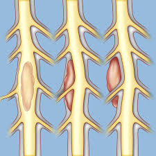 Spine Tumor Surgery in Nagpur