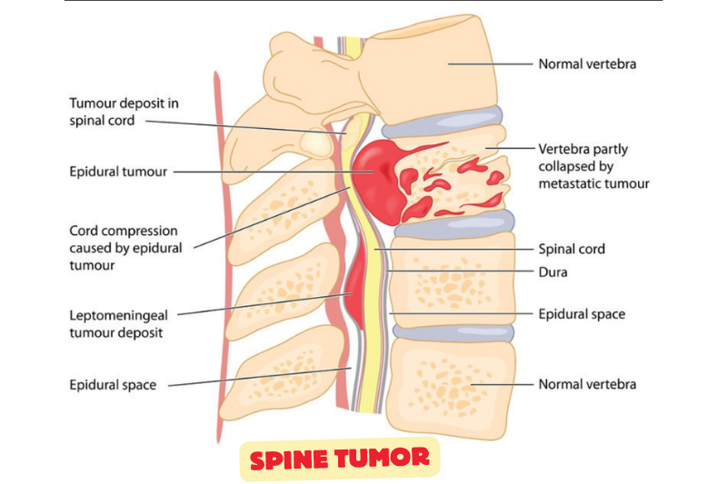 Spine Specialist In Hoshangabad (Narmadapuram)