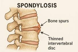 Spondylosis