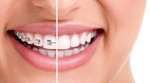 Braces