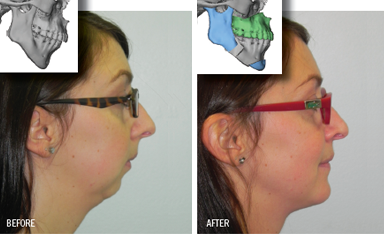 Corrective jaw surgery