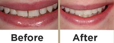 Cosmetic Fillings
