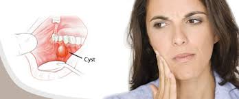 Cysts and Tumors of the Jaw