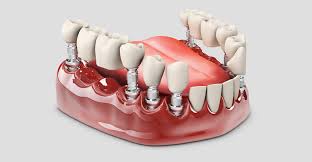 Dental Crowns and Bridges