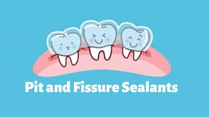 Pit and Fissure Sealant