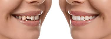 Smile Designing