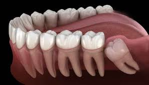 Third Molar Removal