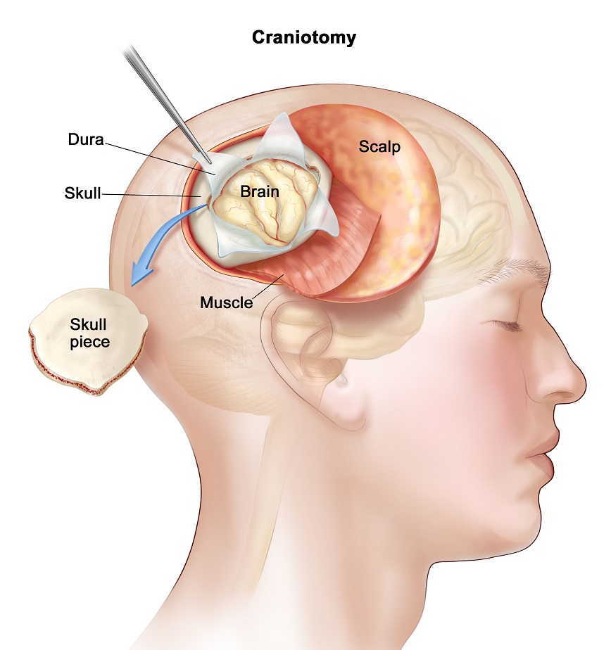 Brain Tumor Surgeon In Nagpur