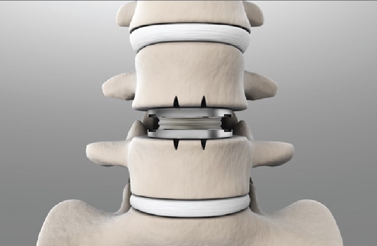 Disc Replacement Surgery In Nagpur
