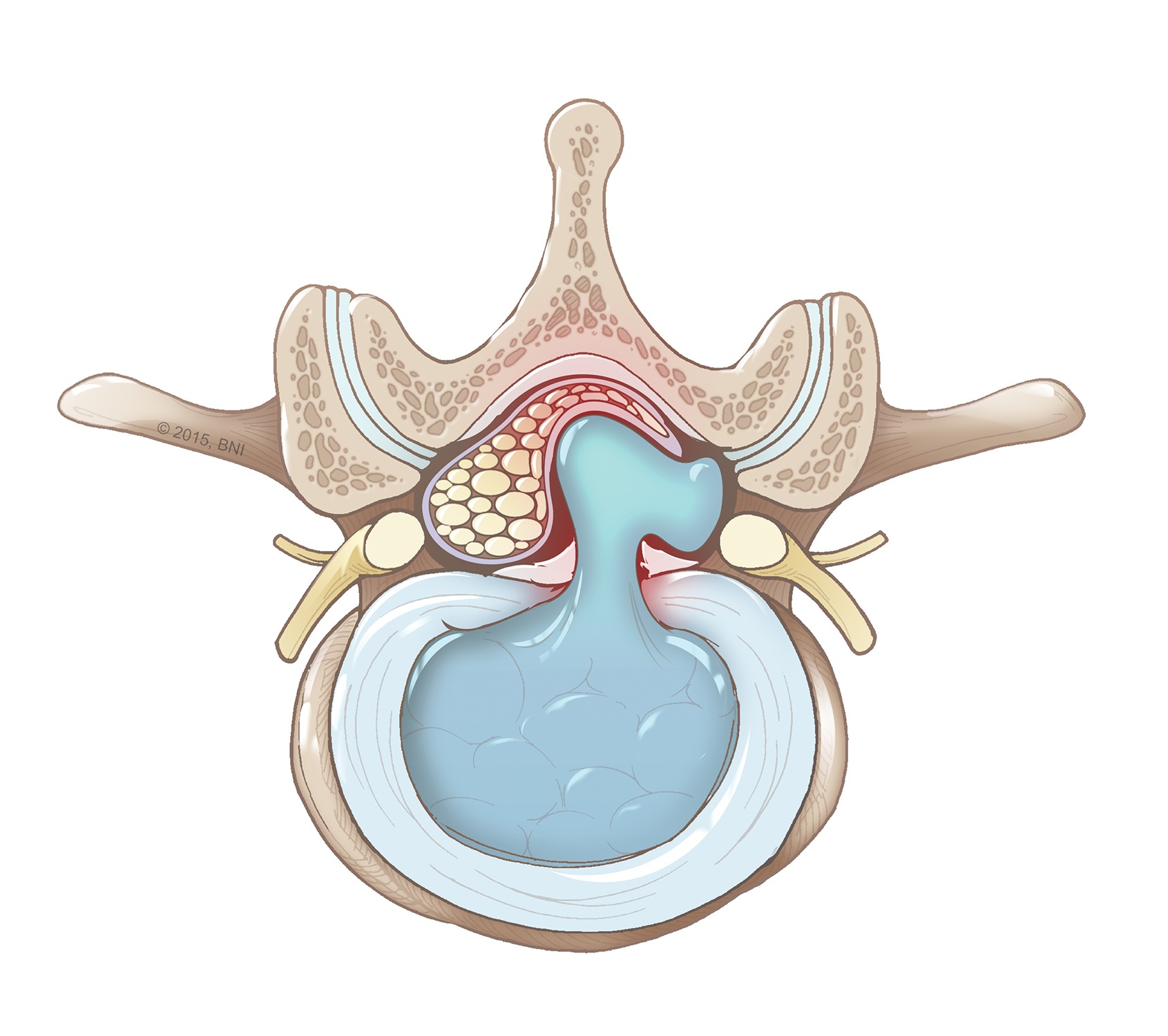 Herniated Disc Treatment In Nagpur