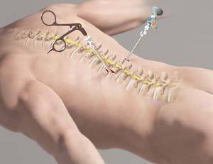 Minimally Invasive Spine Surgery In Nagpur
