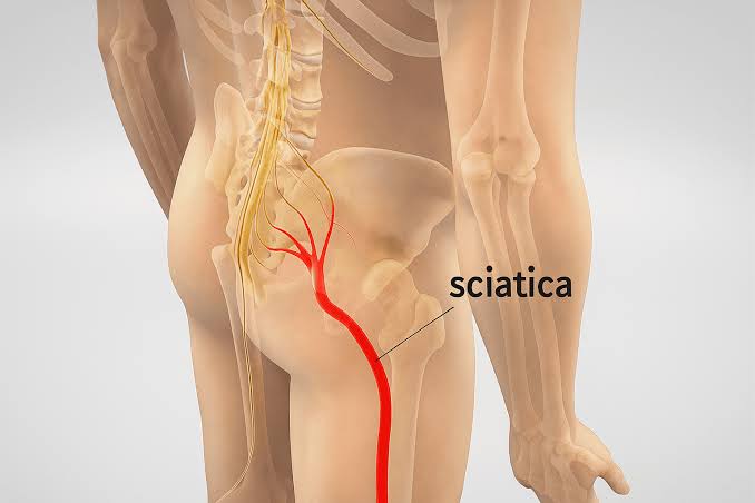 Sciatica Treatment In Nagpur