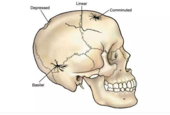 Skull Fracture Surgery In Nagpur