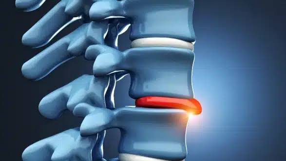 Slip Disc Treatment In Nagpur