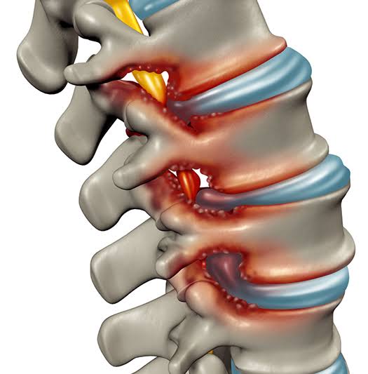 Spine Specialist In Katni