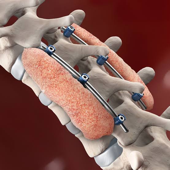 Spine Surgeon In Hoshangabad (Narmadapuram)
