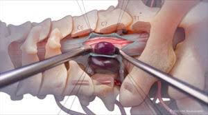 Spine Tumor Surgery In Nagpur