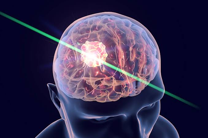 Brain Tumor Treatment In Nagpur
