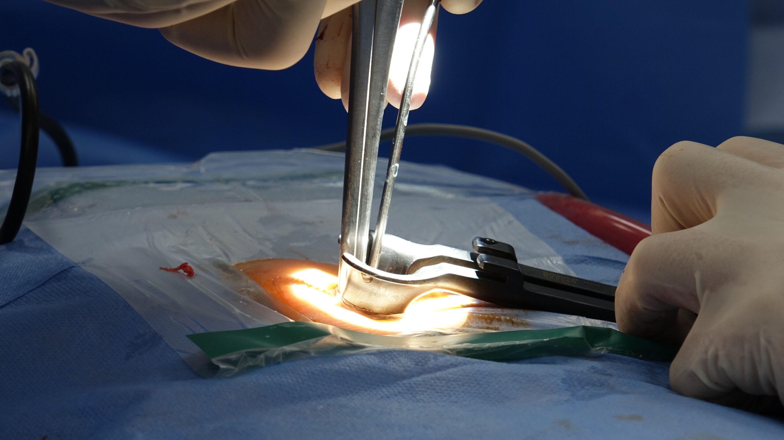 Endoscopic Spine Surgery In Nagpur