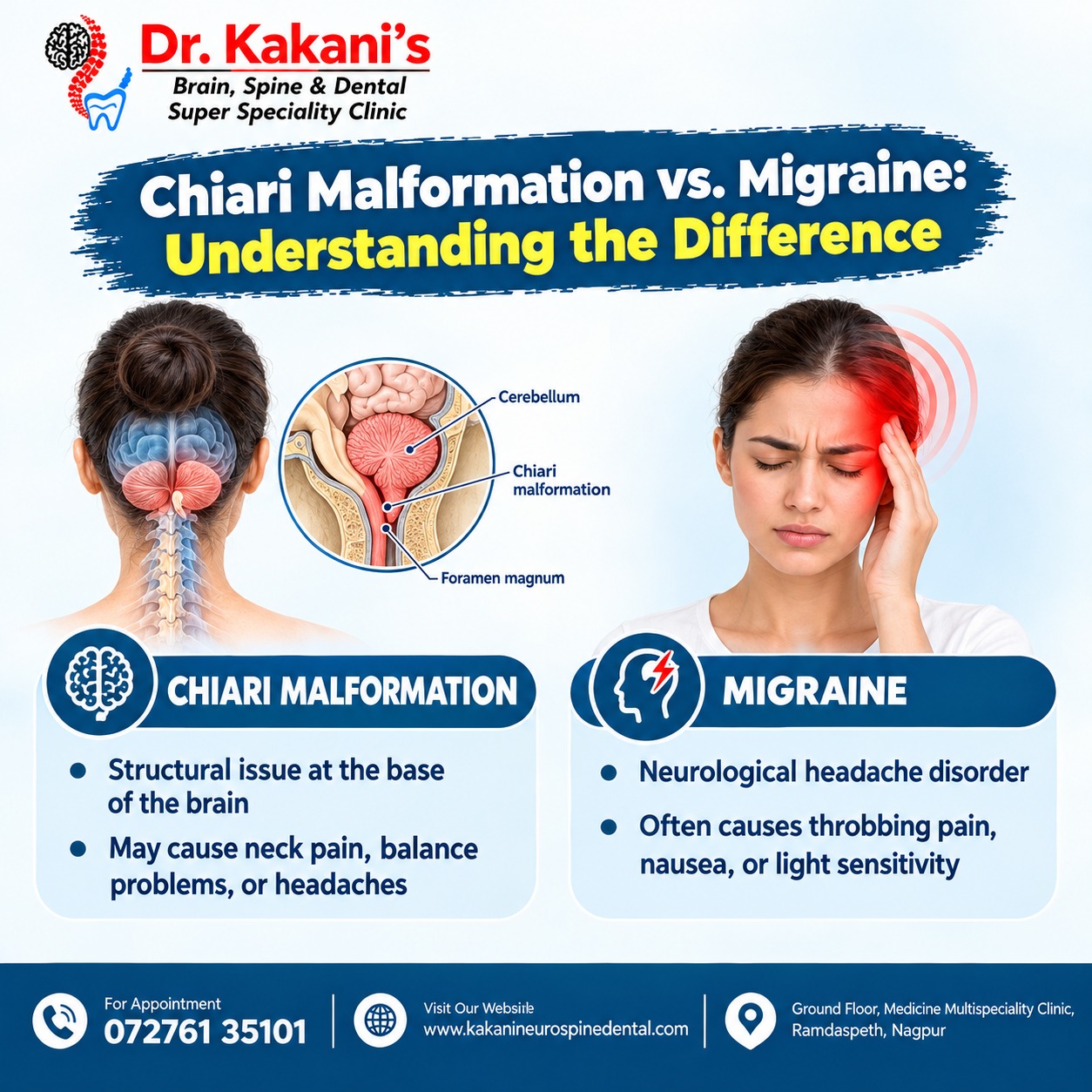 Chiari Malformation vs. Migraine: Understanding the Difference