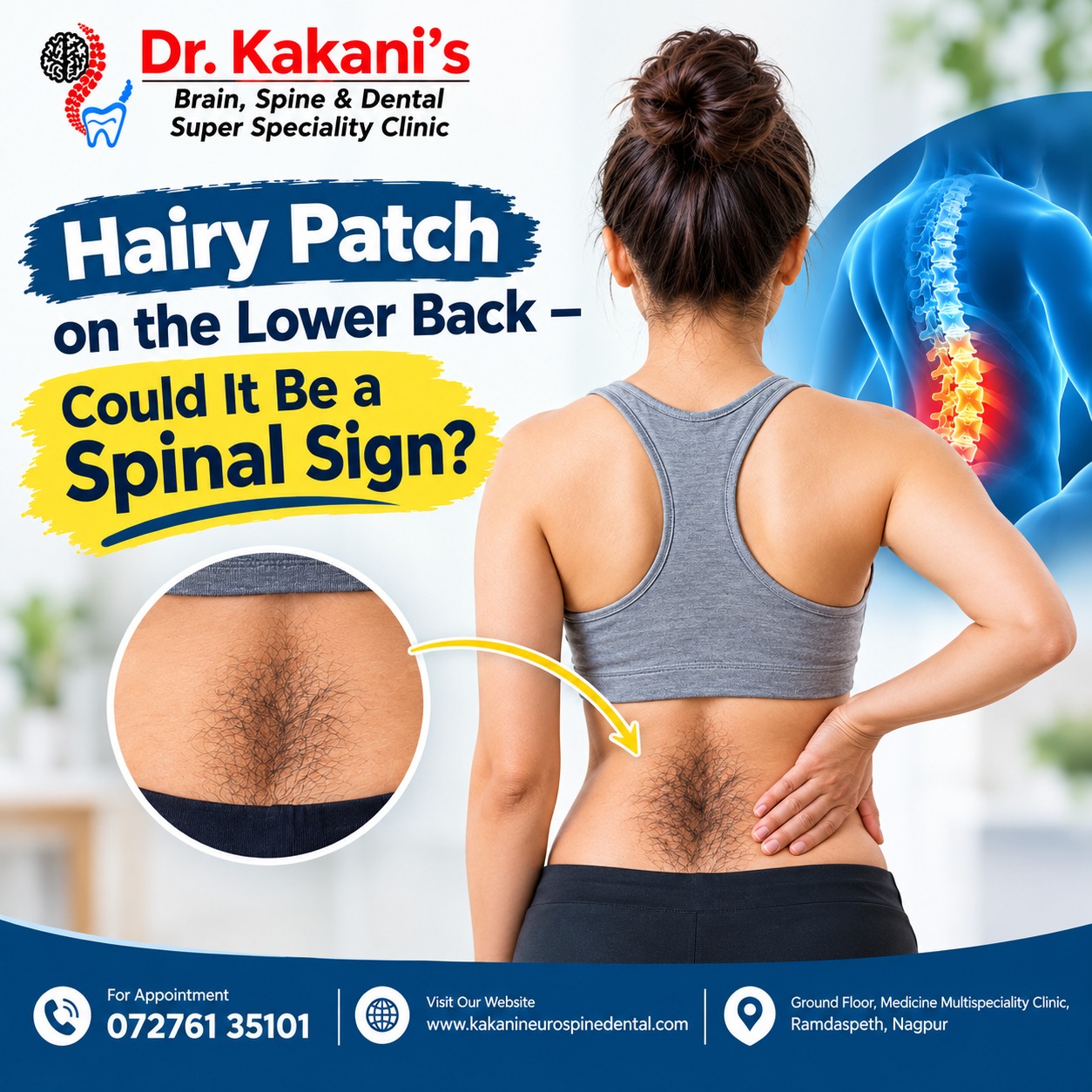 Hairy Patch on Lower Back